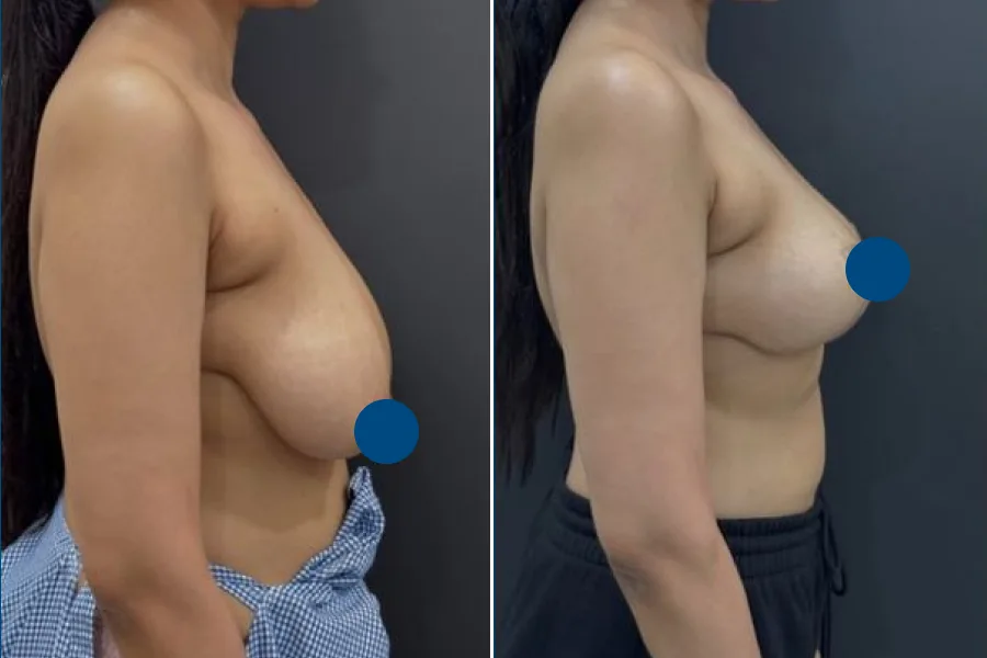 Breast Reduction