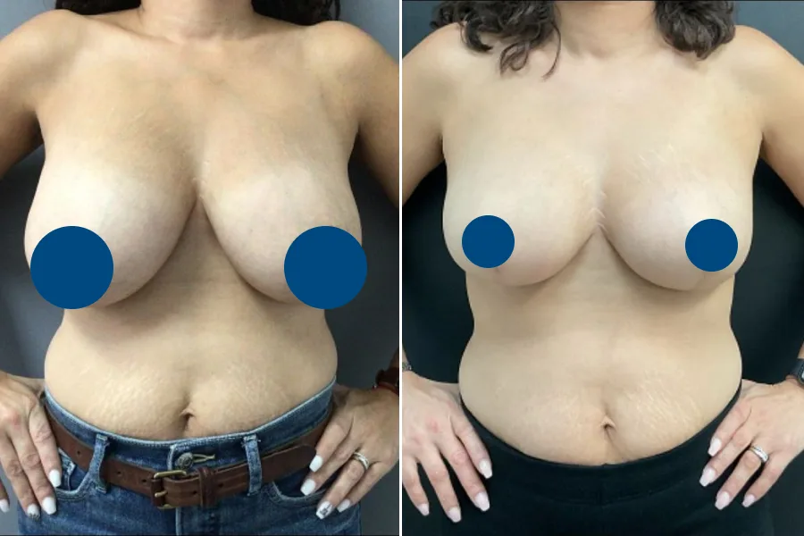 Breast Reduction