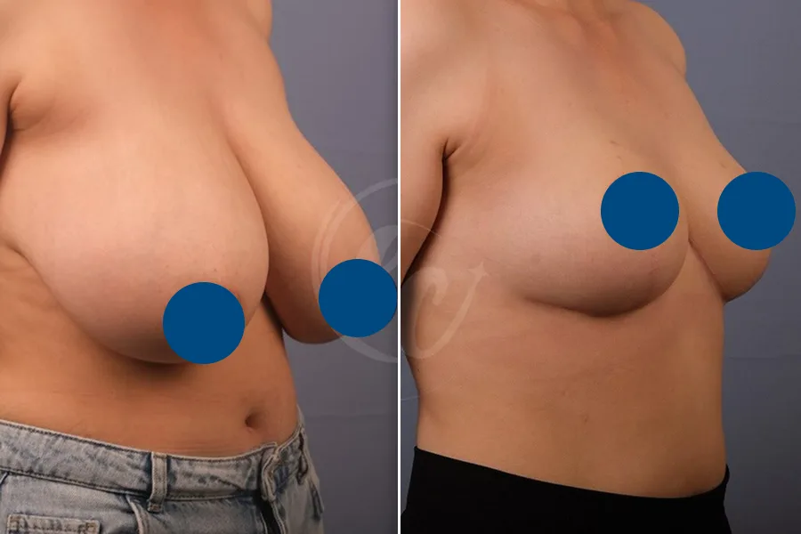 Breast Reduction
