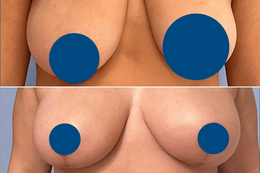 Breast Reduction