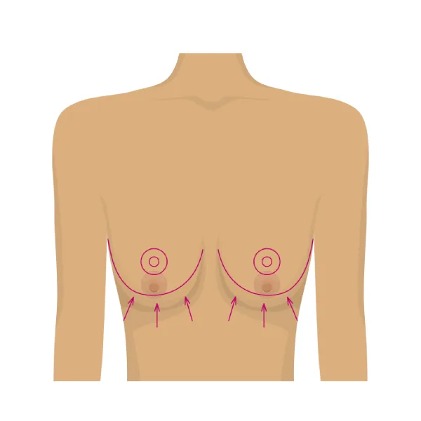 Breast Reduction