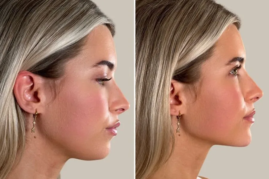 Chin & Jawline Contouring