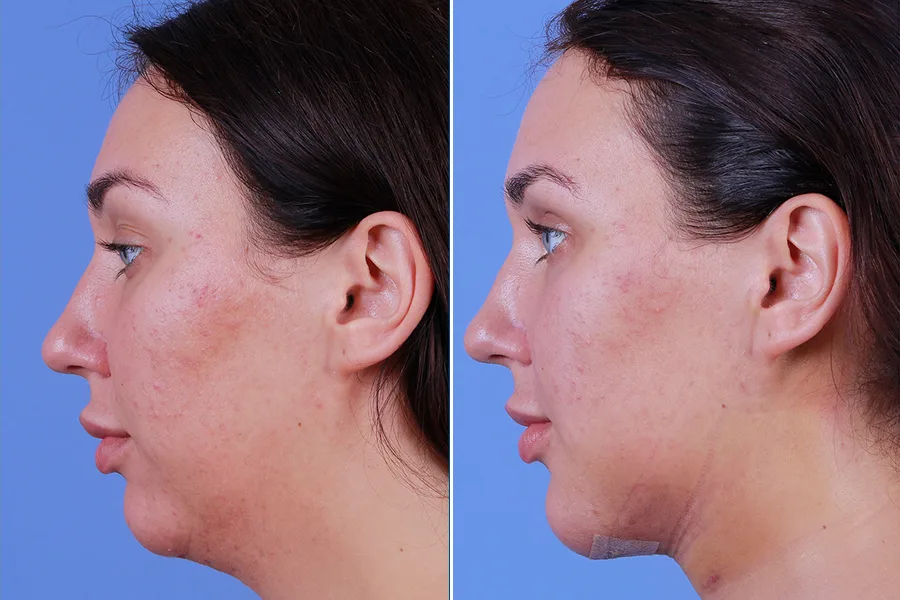 Chin & Jawline Contouring