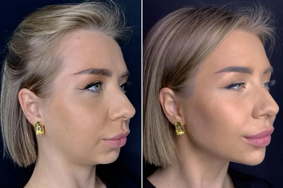 Chin & Jawline Contouring