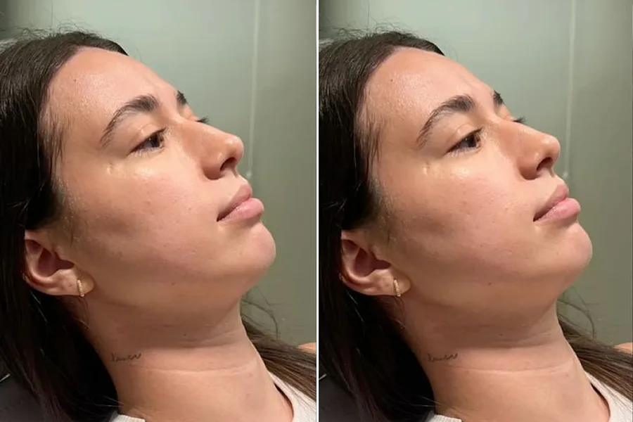 Chin & Jawline Contouring
