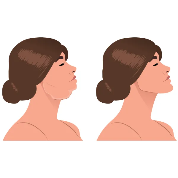 Chin & Jawline Contouring