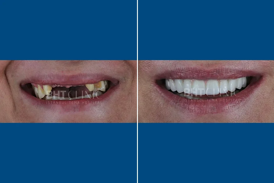 Composite Veneer