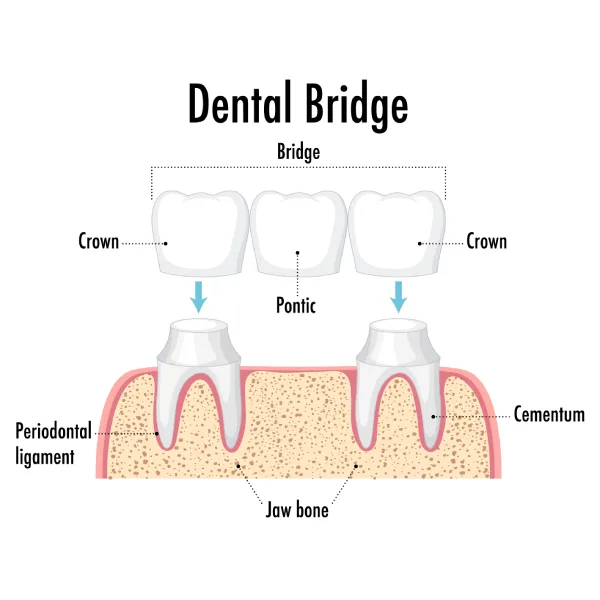 Dental Bridges