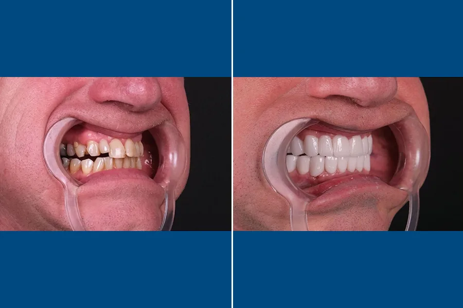 Dental Crowns