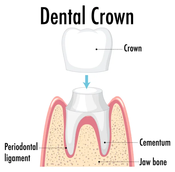 Dental Crowns