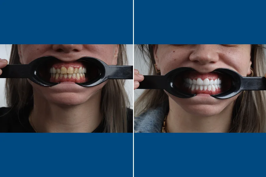 Dental Scaling (Tartar Removal)