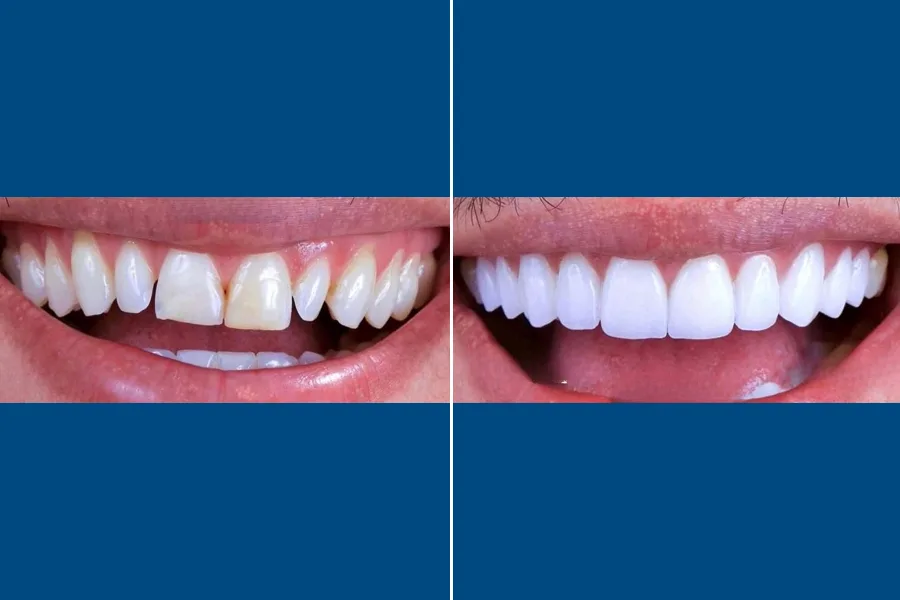 Dental Veneers
