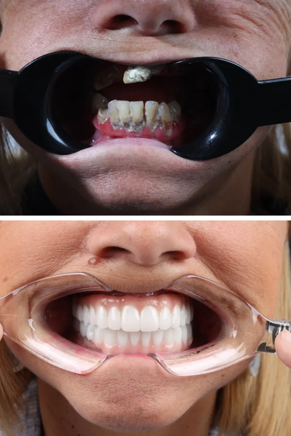 Dentica International case