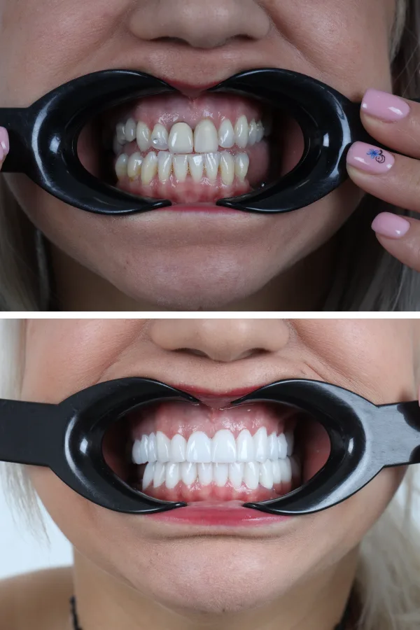 Dentica International case