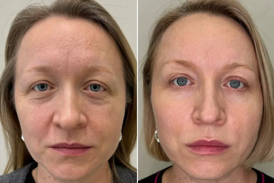 Dermal Fillers