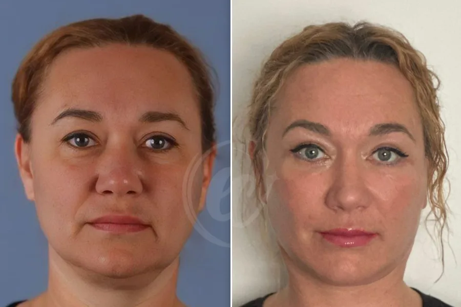 Dermal Fillers