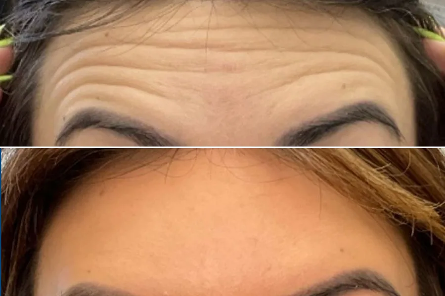Dermal Fillers