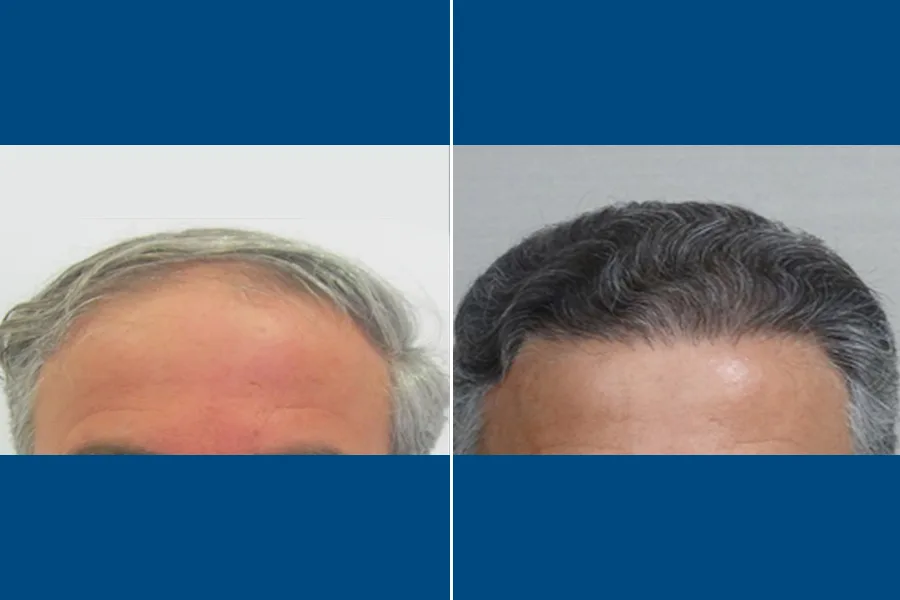 DHI Hair Transplantation: Revive Your Hairline