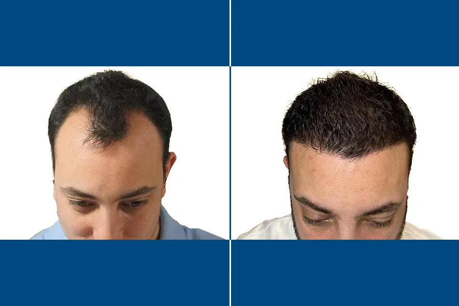 DHI Hair Transplantation: Revive Your Hairline