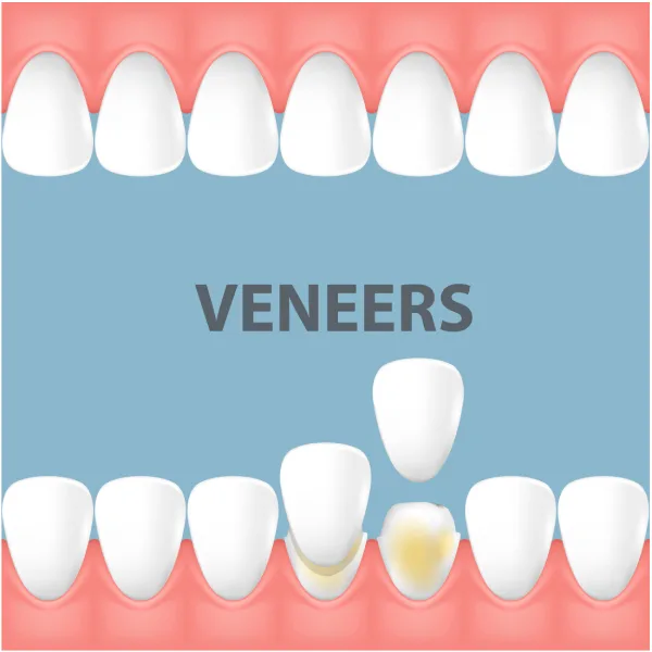 E-Max Veneer