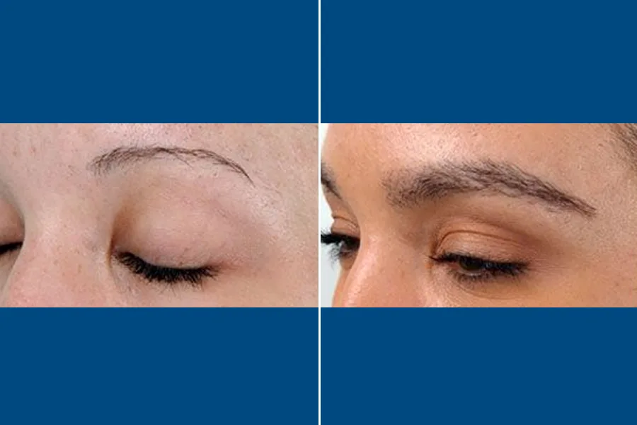 Eyebrow Transplantation: Frame Your Beauty