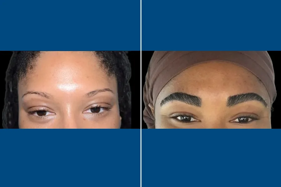 Eyebrow Transplantation: Frame Your Beauty