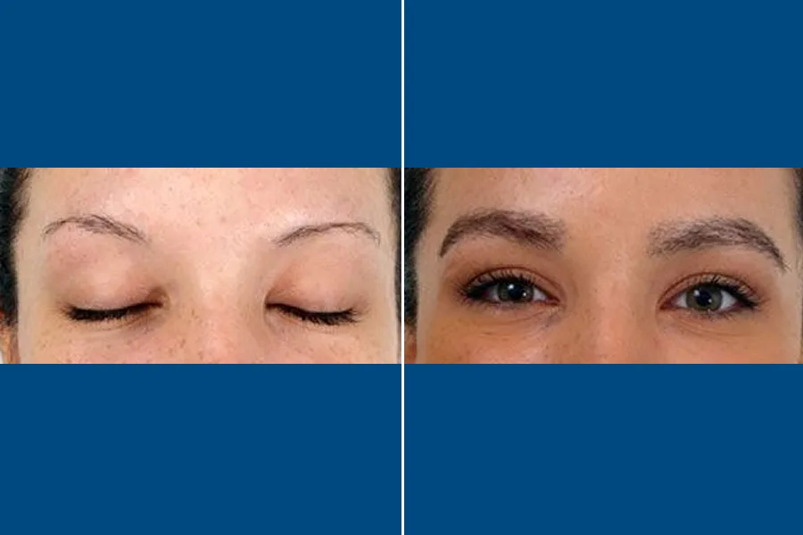 Eyebrow Transplantation: Frame Your Beauty