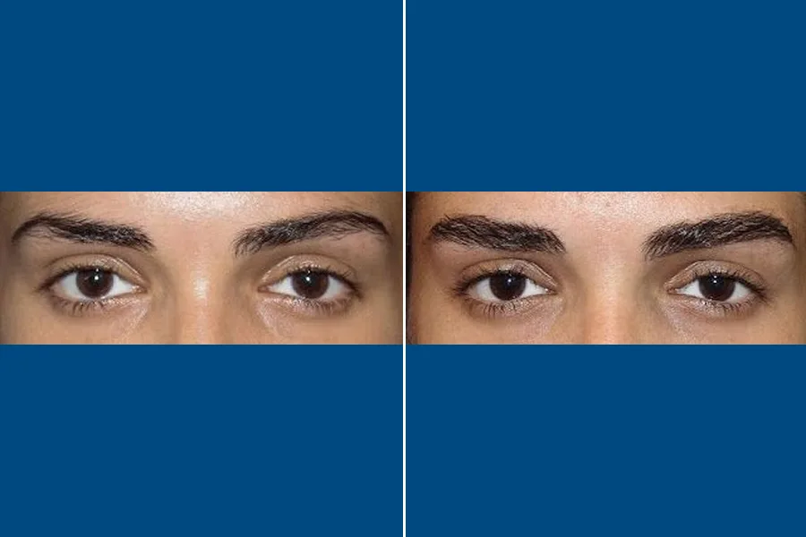 Eyebrow Transplantation: Frame Your Beauty