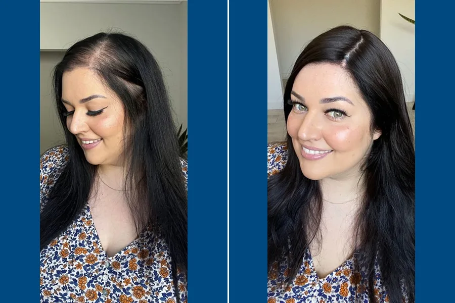 Female Hair Transplantation: Restore Your Radiance