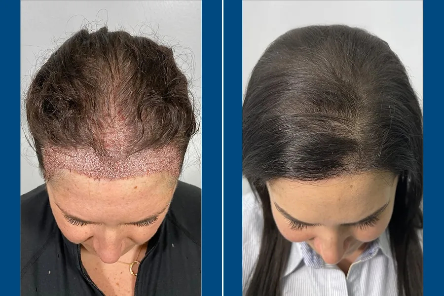Female Hair Transplantation: Restore Your Radiance
