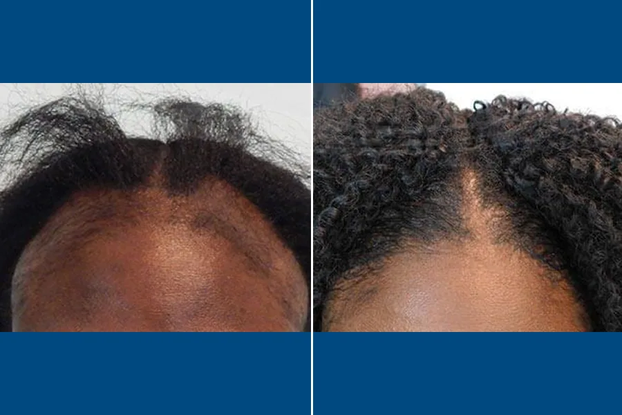 Female Hair Transplantation: Restore Your Radiance