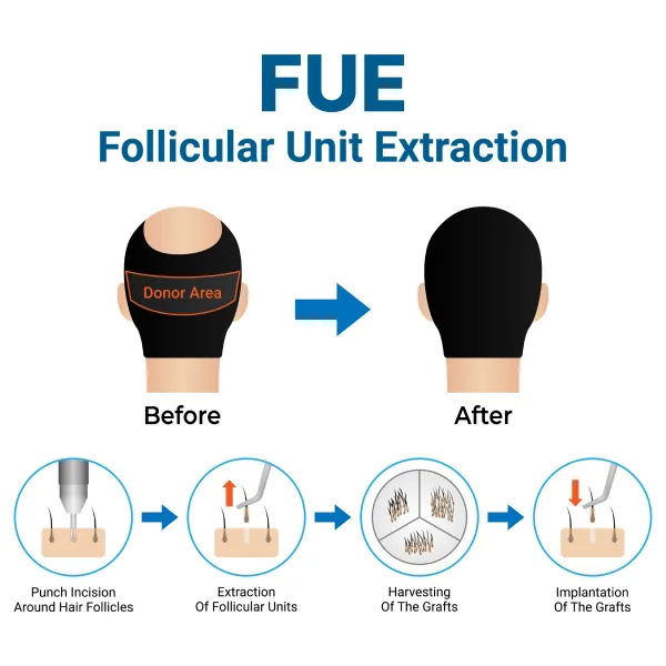 FUE Hair Transplantation