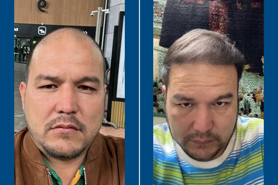 FUT Hair Transplantation: Restore Your Hairline