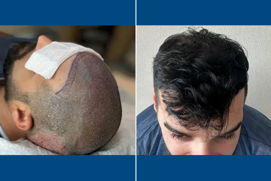 FUT Hair Transplantation: Restore Your Hairline