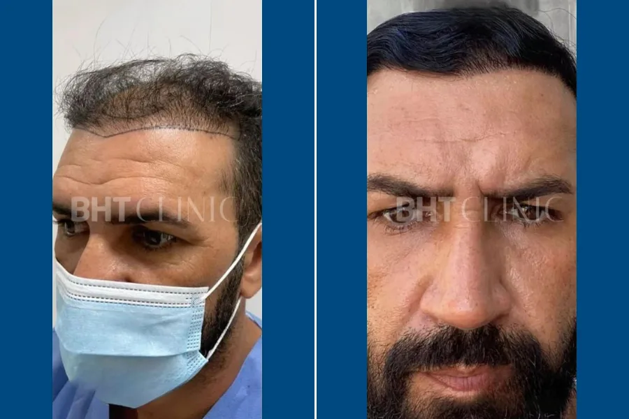 FUT Hair Transplantation: Restore Your Hairline