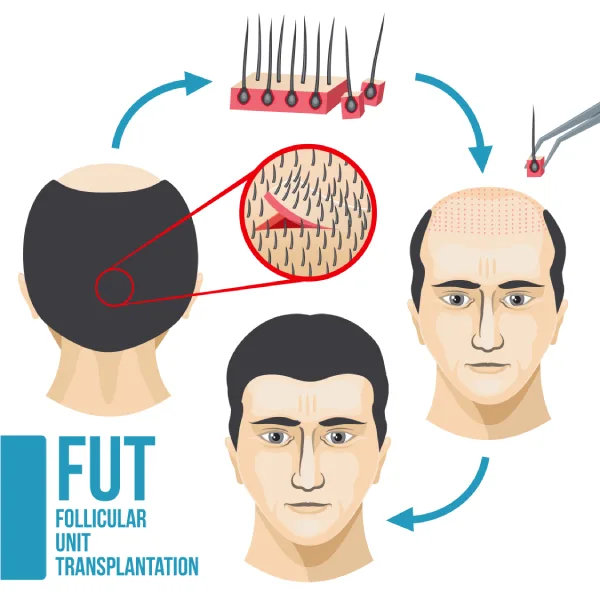 FUT Hair Transplantation