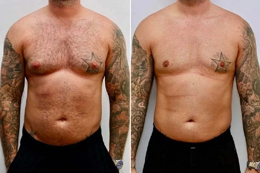 Gynecomastia Surgery