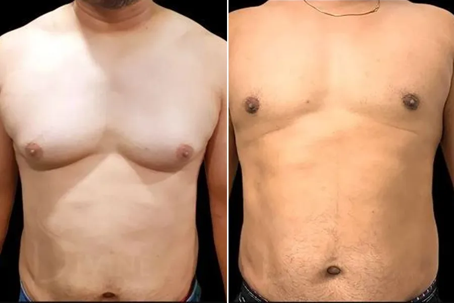 Gynecomastia Surgery
