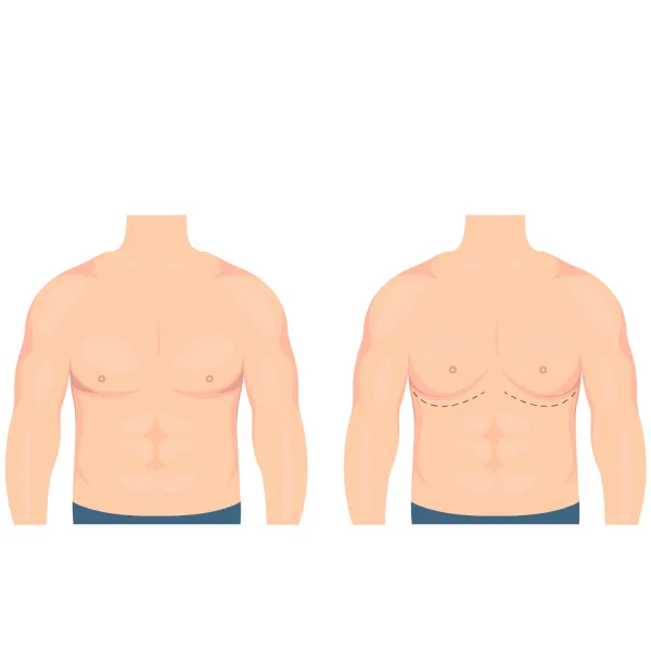 Gynecomastia Surgery