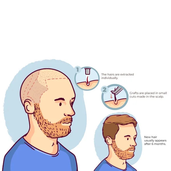Hair Transplantation