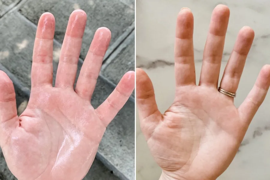 Hyperhidrosis Treatment (Excessive Sweating)