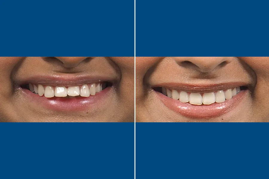 Invisalign Clear Aligners
