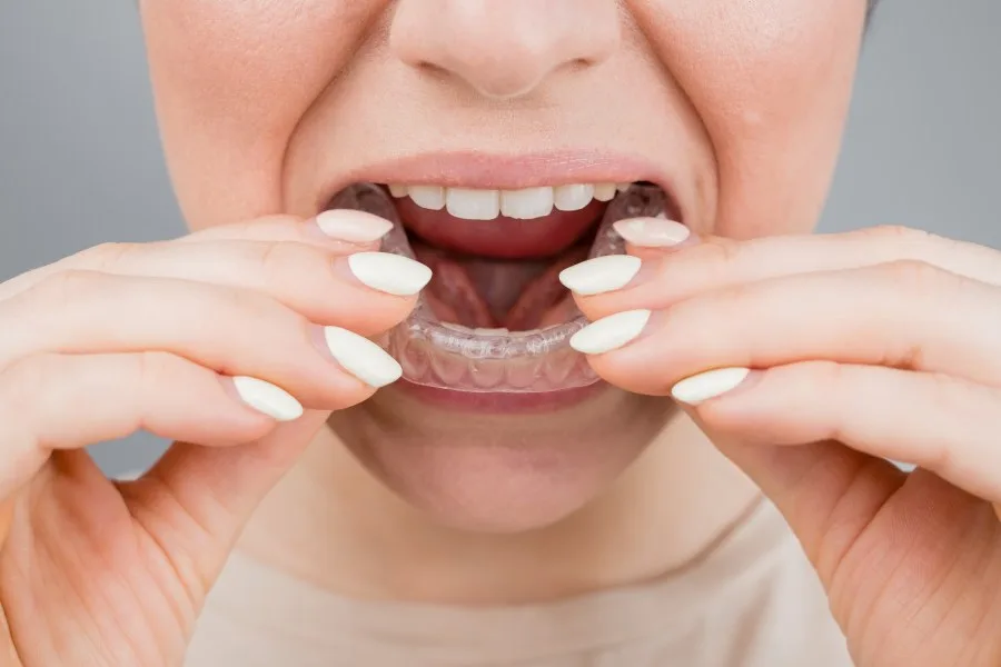 Invisalign Clear Aligners