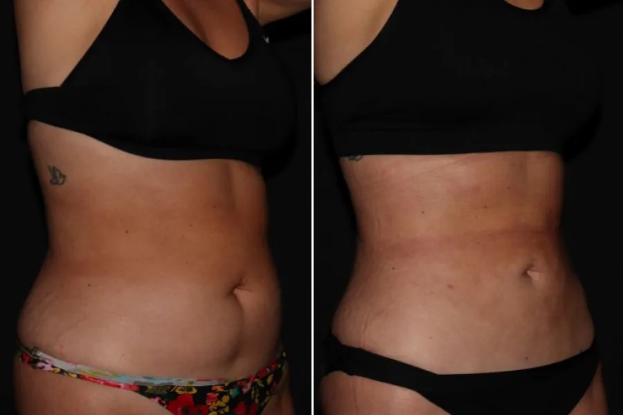 Laser Lipolysis