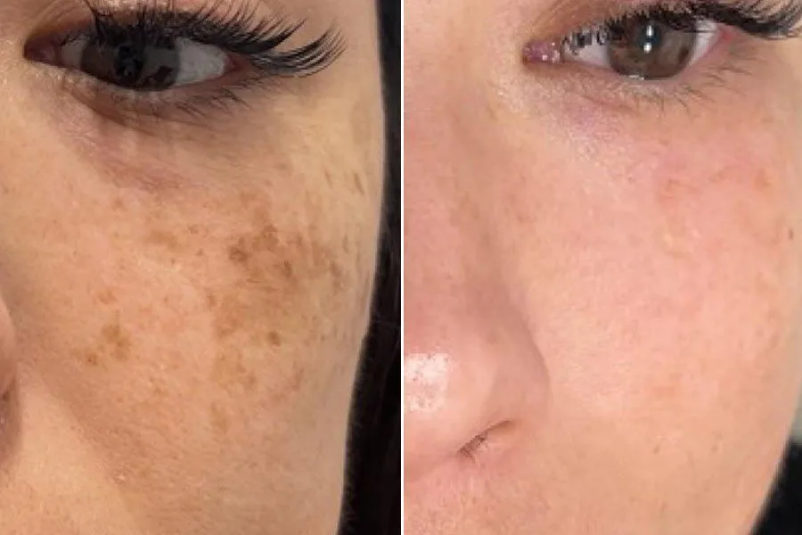 Laser Skin Resurfacing