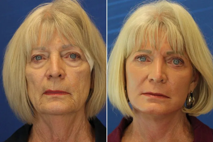 Laser Skin Resurfacing