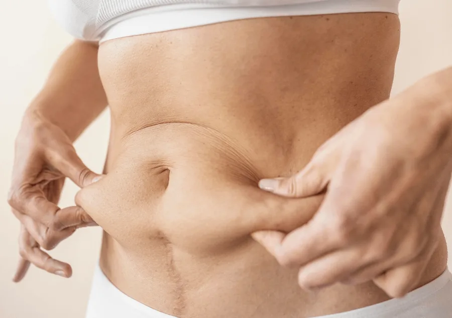 شفط الدهون: حسّن قوامك page background