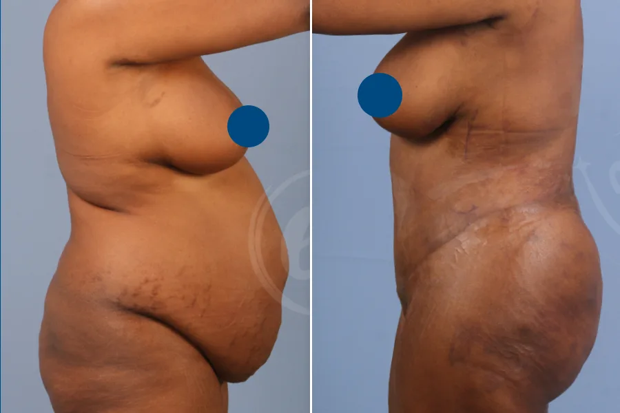 Liposuction