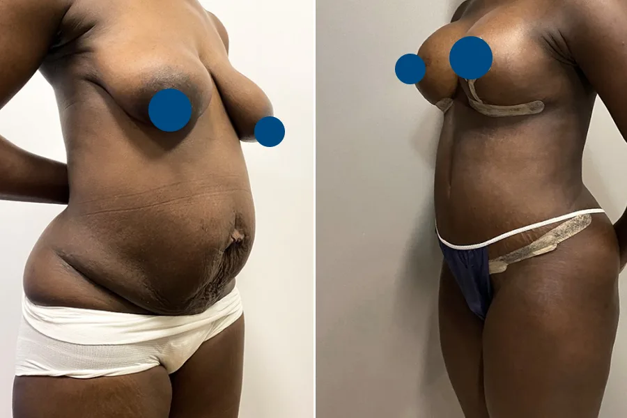 Liposuction