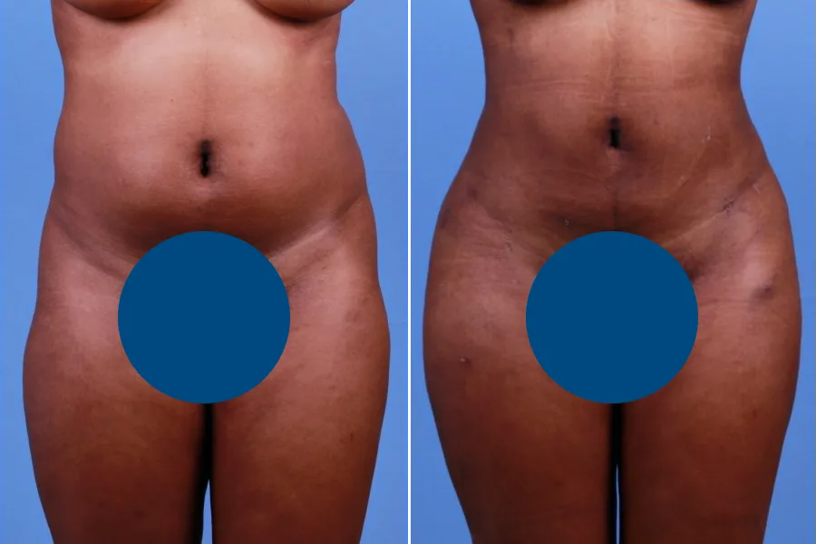 Liposuction